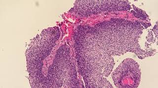 Invasive Non Keratinizing Squamous Cell Carcinoma Moderately Differentiated [upl. by Andrade]