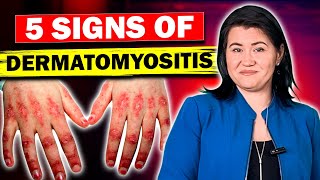 5 Signs of Dermatomyositis and Polymyositis [upl. by Ayahsal]