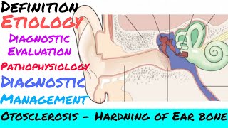 Otosclerosis  Nursing Sagar [upl. by Ahsatam13]