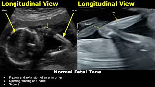 Fetal Biophysical Profile Ultrasound Normal Vs Abnormal Values  Fetus BreathingTone BPSBPP USG [upl. by Fryd836]