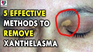 5 Effective Methods to Remove Xanthelasma  Best Health Tips for CHRONIC DISEASES [upl. by Relly317]