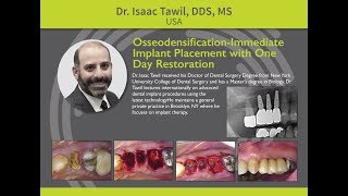 Osseodensification Immediate Implant Placement with One Day Restoration  Dr Isaac Tawil [upl. by Kylah]