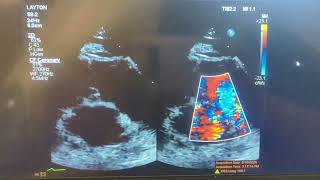 Patient presents to the clinic with chest pain and you see this short axis what do you suspect [upl. by Leah]