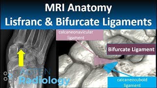 Lisfranc and Bifurcate Ligaments MRI Anatomy [upl. by Nnovahs]