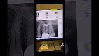 Root canal therapy of tooth 14 [upl. by Sellma]