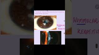 Nummular keratitis cornea keratitis eyes ophthalmology [upl. by Glimp]