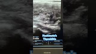 Hashimoto Thyroiditis reels videos thyroid hypothyroidism ultrasound ultraradiology [upl. by Maximilian]