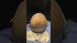 Widow’s peak and crown hair loss Vinci Hair transplant saves vincihairclinic shorts [upl. by Sukcirdor]