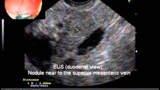 Diagnosis of Insulinoma by EUS [upl. by Ahtreb]