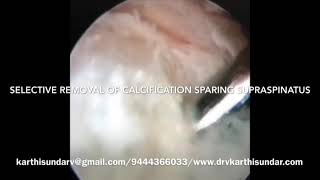 CALCIFIC TENDINITIS OF SUPRASPINATUS Arthroscopic removal of calcification sparing supraspinatus [upl. by Ayrolg]