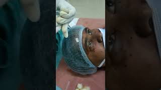 Peribulbar Block  Eye surgery  ophthalmology  local anesthesia  eye surgery [upl. by Iadahs]