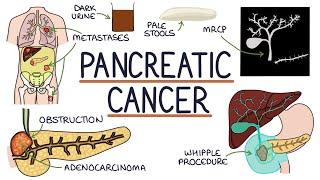 Understanding Pancreatic Cancer [upl. by Ahsetal]