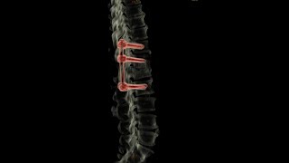 Pedicle Screw Fixation of Lumbar body Compression Fracture [upl. by Harold]