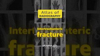 How to treat Intertrochanteric Fracture 🦵🔧 shorts fracture medical [upl. by Arhas529]