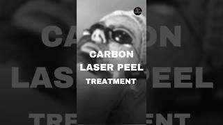 Carbon Laser Peel Treatment for Face  Procedure  Carbon Laser Peel Treatment in Delhi shorts [upl. by Doy]