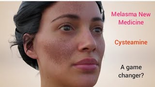 Melasma New Medicine  Cysteamine  Is it a game changer melasma melasmacream melasmatreatment [upl. by Drageruaeb]