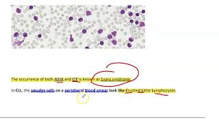 Chronic lymphocytic leukemiaCLL [upl. by Rudyard]