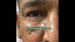 Entropion correction Jones Procedure [upl. by Yendroc]