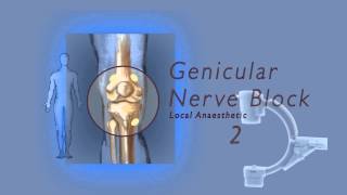 Genicular nerve block by Dr Murli Krishna Pain Specialist Bristol [upl. by Anauqahs101]