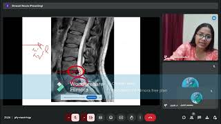 Prolapsed Intervertebral Disc Anatomy of IV Disc Part 2 [upl. by Dinnage]