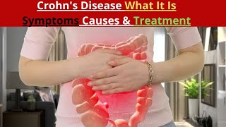 Crohns Disease What It Is Symptoms Causes amp Treatment [upl. by Schriever581]