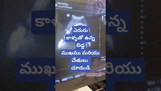 Breech presentation in 9th month drkranthigynecologist తొమ్మిదవ నెల లో ఎదురు కాళ్ళు [upl. by Gemini]