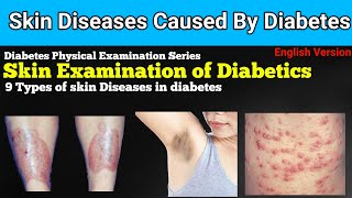 Diabetes  Skin Diseases  viralvideo Allied Doctors SocietyADS [upl. by Nyletak960]