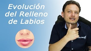 Evolución de Rellenos de Labios [upl. by Swehttam720]