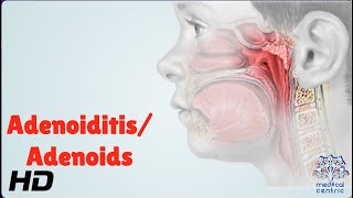 AdenoiditisAdenoids Everything You Need To Know [upl. by Adlihtam746]