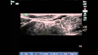 Femoral nerve ultrasound on triangle [upl. by Yesima]