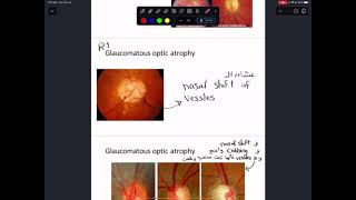 practical ophthalmology 2 [upl. by Euqinommod]