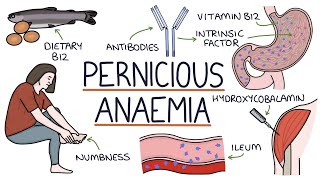 Understanding Pernicious Anaemia B12 Deficiency [upl. by Joiner61]