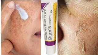 Glyco 6 Cream  glycolic acid  Remove pigmentation  Acne Scars  pimple marks [upl. by Ocihc]