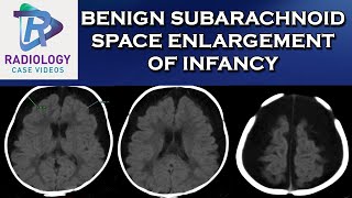 Benign Subarachnoid Space enlargement of infancy [upl. by Octavie]