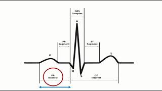 Corrected QT interval QTc calculation with Bazetts formula [upl. by Nicks543]