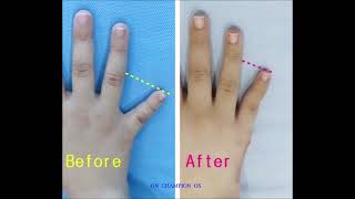 brachydactyly 短指症手術 短指症 단지증 단지증수술 단지증수술후기 braquidactilia عضدي الأصابع брахидактилия [upl. by Sueaddaht]