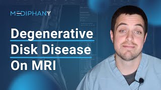 Degenerative Changes of the Lumbar Spine on MRI [upl. by Anaele]