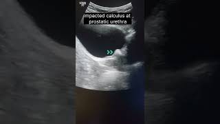 calculus prostatic urethra  Vasical calculus ultrasound [upl. by Adidnere]