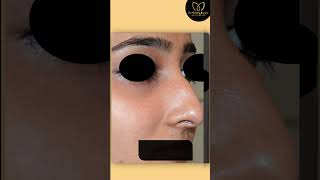 Rhinoplasty Surgery in Delhi  Nose Before and After Result  Dr Monisha Kapoor shorts [upl. by Naloj]