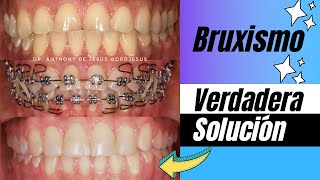 TRATAMIENTO PARA EL BRUXISMO CON BRACKETS ANTES Y DESPUÉS  CASO EXTREMO REAL [upl. by Seka]