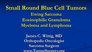 Orthopedic Oncology Course Small Round Blue Cell Tumors Ewing Sarcoma Lymphoma  Lecture 8 [upl. by Rosenthal]