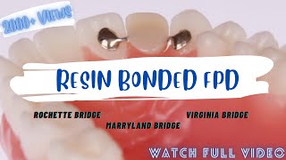 RESIN BONDED FPD  ROCHETTE BRIDGE  MARRYLAND BRIDGE  VIRGINIA BRIDGE fpd prostho [upl. by Ahsie]