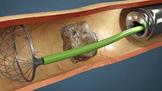 Como é feita a Cirurgia de Pedra nos Rins Vídeo da cirurgia em 3D [upl. by Kristy915]