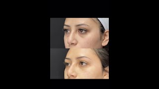 Under Eye Filler Treatment with PA Cathy  Ageless MD [upl. by Yde]