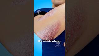 How Does Psoriasis Happen shorts viralvideo skincare  Creativelearning3d [upl. by Letnoj]