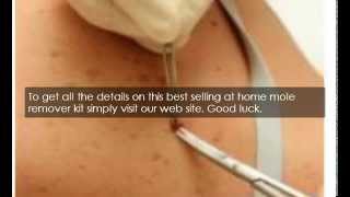 How To Remove A Mole At Home Safely [upl. by Peggie360]