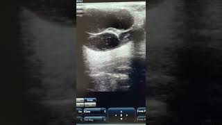 Reactive cervical lymph node reels ultrasound video neck nodes tb ultraradiology [upl. by Nivi]