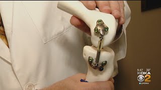 New Device Aims To Delay Knee Replacements For Osteoarthritis Patients [upl. by Pittman]