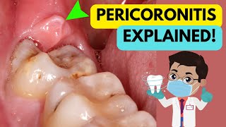 PERICORONITIS EXPLAINED IN 5 MINUTES CAUSE SYMPTOMS DIAGNOSIS AND TREATMENT [upl. by Eintruoc]