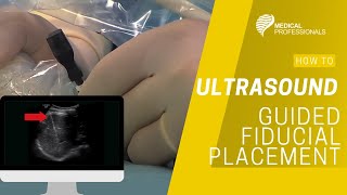 Ultrasound Guided Fiducial Placement for Stereotactic Radiotherapy [upl. by Adalai]